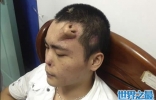 把鼻子长到额头上，还能呼吸(图)