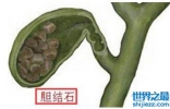 世界上最大的人体胆结石，重达12.58千克