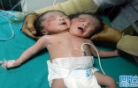 孟加拉诞生极为罕见的“双头女婴” 数千村民跑到医院朝圣