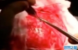 寄生虫侵袭人脑 医师动刀从病人脑部取出透明巨型囊肿吓坏所有人 ...