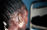 揭秘埃博拉病人融化惨状，唉博拉病毒活死人图片曝光