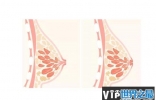 女生乳头凹陷是怎么回事