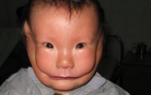 江西女子生下恐怖的婴儿 眼睛看起来像青蛙（畸形婴儿）