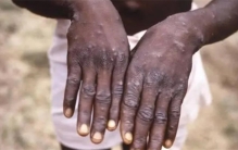 全球超过5000人确诊 这种病症会不会席卷全球？（猴痘）