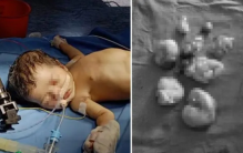 印度女孩的体内有八个胎盘 这是怎么回事？（婴儿胎盘）