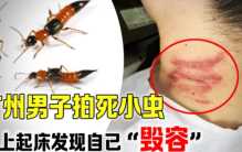 广州男子拍死一只小虫子 醒来之后发现自己毁容（隐翅虫）