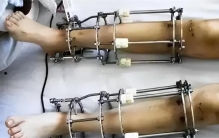 花20万做断骨手术 居然只为长高7cm（增高手术）