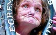 世界上最丑的人 安妮伍兹长相怪异 (畸形病症)