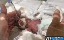 世界最小男婴 重量仅268克已平安出院(体重最轻)