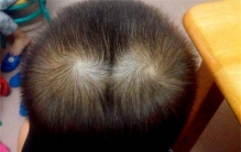 每个人头顶上的旋 为啥都不一样（头顶毛流）