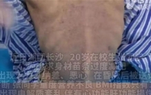 女大学生疯狂减肥 居然只剩60斤（过度减肥）