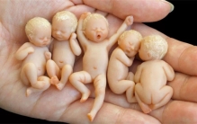 人类最小婴儿  出生时不到1斤  医生说活不过3个月  如今怎么样了