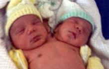巴西出现的双头婴儿 两个孩子共用一个身体（双头人）