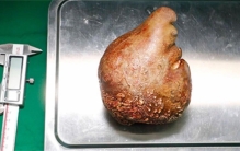 世界上最大的肾结石 足足有801g（肾结石）