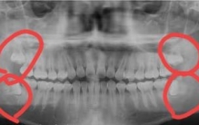怎么知道自己会不会长智齿(长智齿脸都肿了)