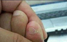 为什么脚趾甲小脚趾两瓣(脚趾分两半)