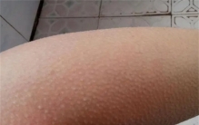 人在紧张和恐惧时 为什么会起鸡皮疙瘩（皮肤反应）