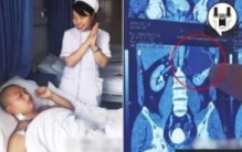 世界上肾最多的人，体内竟然有5个肾脏