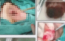 前列腺癌切除精囊有影响吗「早期阴茎癌切除手术最多能活多久」