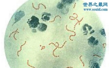 熊猫病，小儿自体免疫神经精神疾病(无法预防)