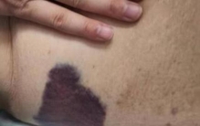 诡异的淤青急诊医生寻找背后真相