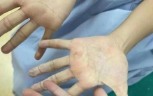 俩女孩遭恶作剧,手掌被502胶牢牢粘住,小孩玩502胶手被粘住怎么办