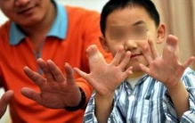 世界上手指脚趾最多的人:印度男孩多指畸形(34根手脚指)