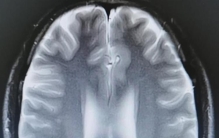 吃生肉脑子里有虫,男子吃生牛肉长寄生虫