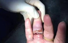 打保龄球戴戒指 手指上的肉会被活生生的剥落（注意事项）