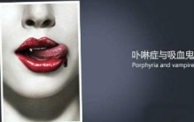 杭州护士吸血鬼病事件真相解密，原来是父母近亲结婚导致