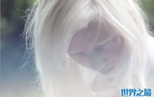 患有白化病能活多久，其实寿命和正常人并无差别