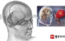 警惕这种突发头痛会致死
