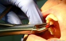 拔牙导致死亡案例,拔牙引起死亡的原因