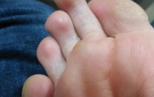 鸡眼是什么?蚕豆大小的淡黄色锥形老茧(摩擦压迫导致)