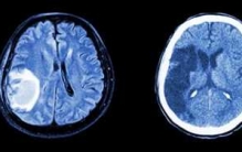 脑震荡多久能恢复正常?脑震荡对人体的十大危害