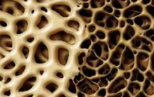 什么原因导致骨质疏松?骨质疏松的十大症状和治疗