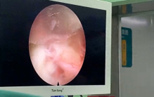 有时候突出的椎间盘机械性刺激和炎症因子刺激才是疼痛最根...