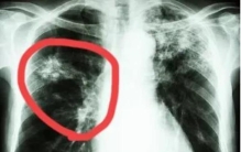 当前治疗肺结核的主要方法是什么,肺结核免费治疗