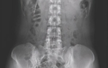 04年云南26岁女子尿血发现体内有26根缝衣针医生1岁前扎的