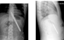 养生会检查者惊呆了B超惊现诡异物体小龙虾在大叔胃里游泳