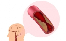 爸妈年纪大了，颈动脉容易长斑块！这样做，斑块能缩小