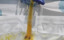 头皮发麻！男子胆管爬满密密麻麻的虫……曾在半年前吃过这道美味，很多人都爱吃