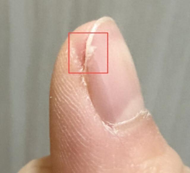 求助!指甲为什么总从这个地方断开啊?是缺钙吗?