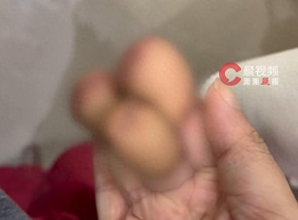 机械“咬”手,女子右手三指不保!危险瞬间往往藏在最熟悉的环节中