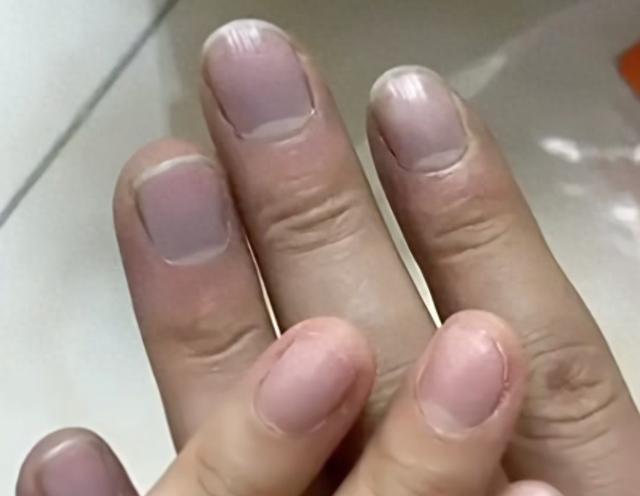 男子指甲发紫拒就医，几天后突发胸痛！这几个信号要警惕