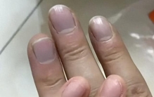 男子指甲发紫拒就医，几天后突发胸痛！这几个信号要警惕
