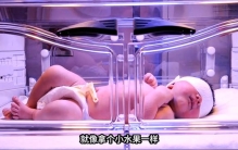 世界上最小的早产婴儿,出生时体重只有245克,只有一颗苹果大小